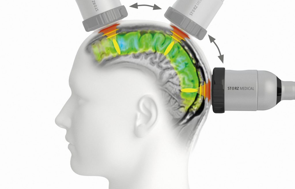 Alzheimerjeva bolezen