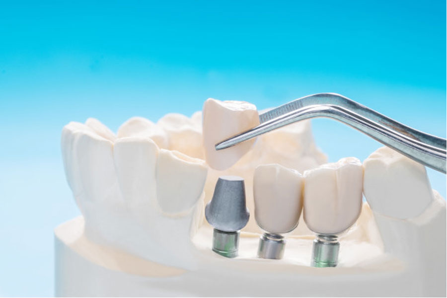 Zobni implantati cenik